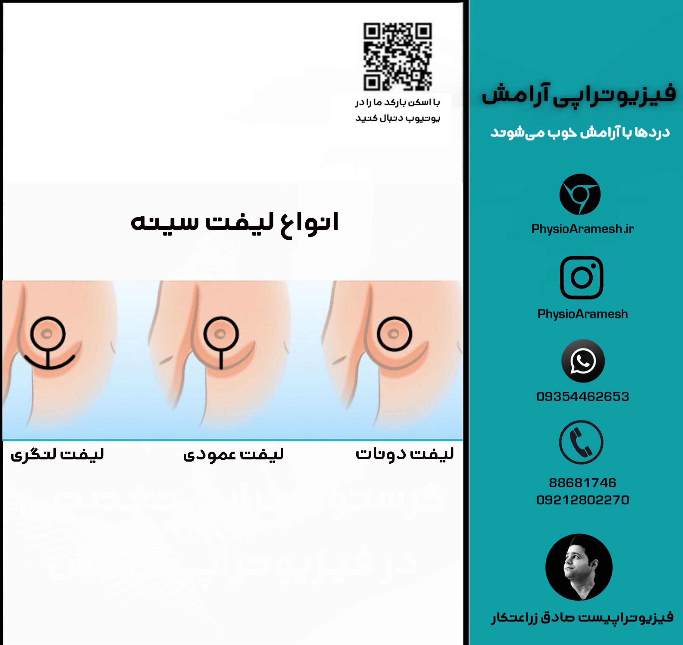 انواع لیفت سینه